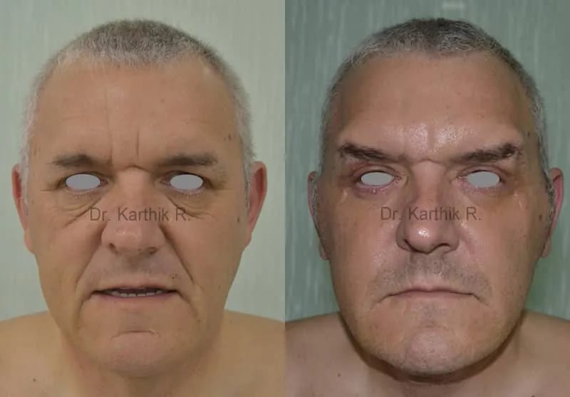 facelift before and after photo by chennai plastic surgery in india