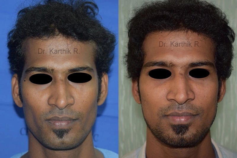 fat graft fat fill fat transfer before and after photo by chennai plastic surgery
