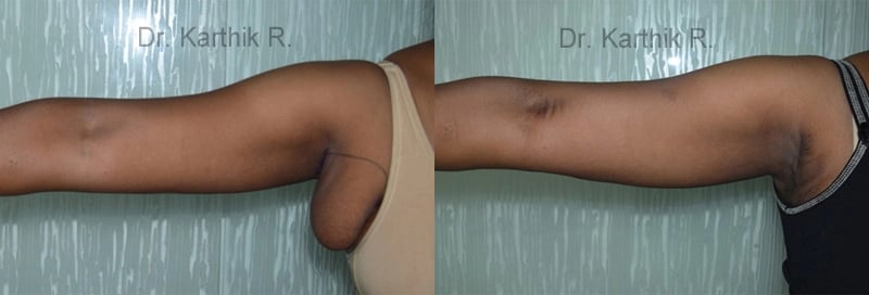 axillary tail of breast before and after photo by chennai plastic surgery in india
