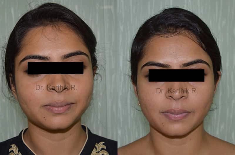 exilis before and after photo by chennai plastic surgery in india