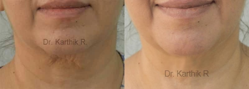exilis before and after photo by chennai plastic surgery in india