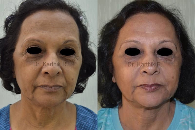 thread lift before and after photo by chennai plastic surgery in india