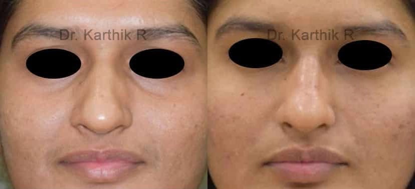 dermal fillers before and after photo by chennai plastic surgery in india