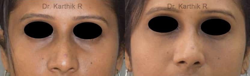 dermal fillers before and after photo by chennai plastic surgery in india
