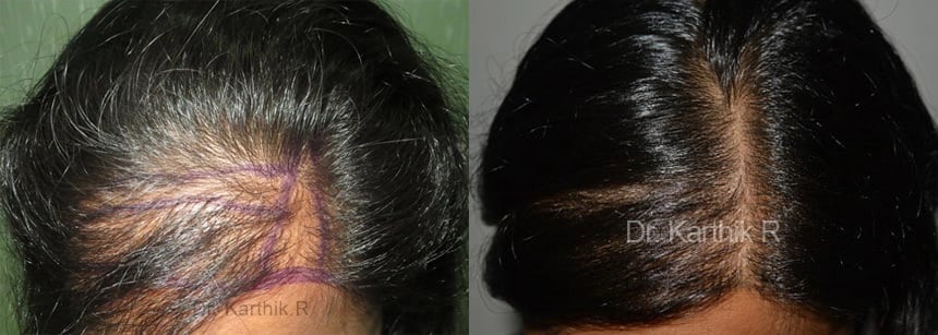 female hair transplant before and after photo by chennai plastic surgery in india