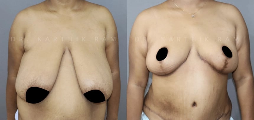 breast reduction breast lift before and after photo by chennai plastic surgery in india