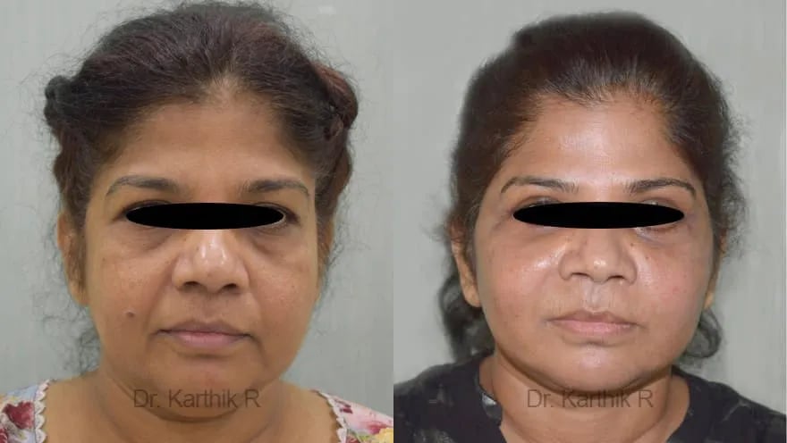 facelift before and after photo by chennai plastic surgery in india