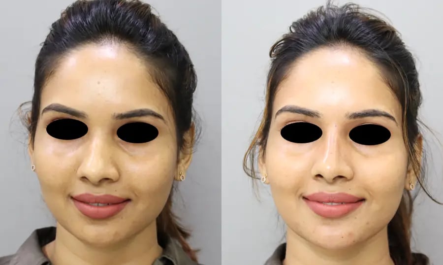 dermal fillers before and after photo by chennai plastic surgery in india