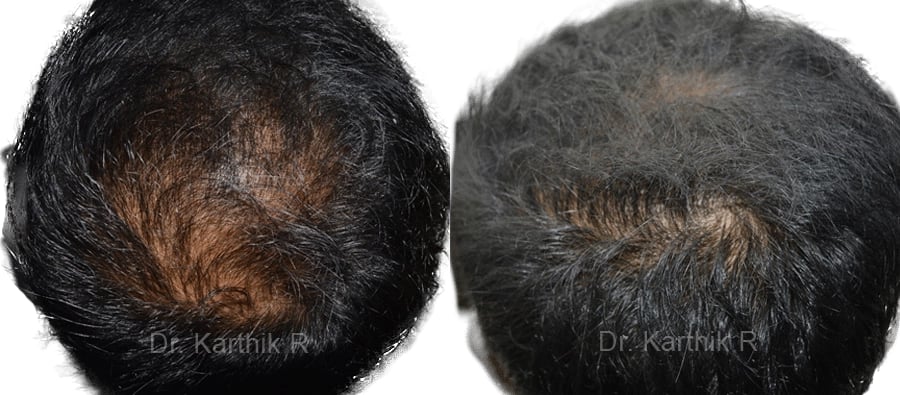 dermaroller scalp before and after photo by chennai plastic surgery in india