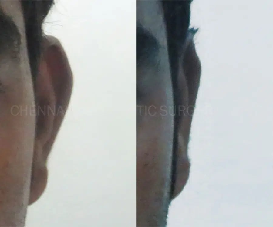 otoplasty ear correction before and after photo by chennai plastic surgery in india