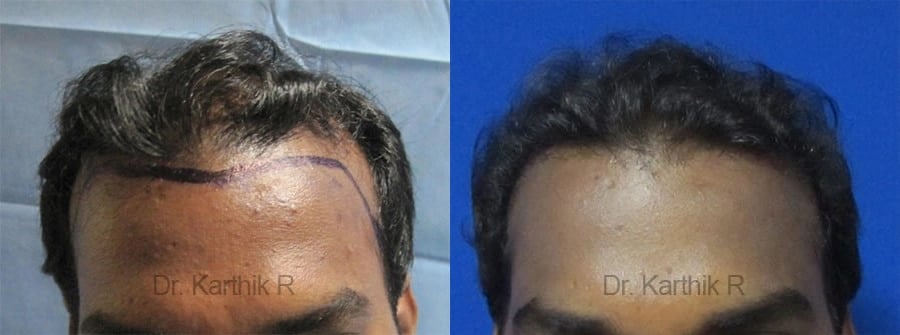hair transplantation before and after photo by chennai plastic surgery in india
