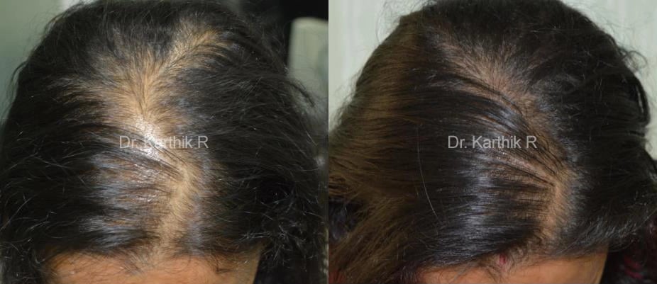 dermaroller scalp before and after photo by chennai plastic surgery in india