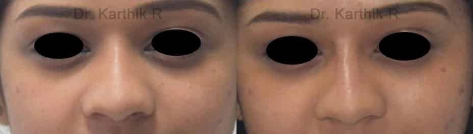 dermal fillers before and after photo by chennai plastic surgery in india