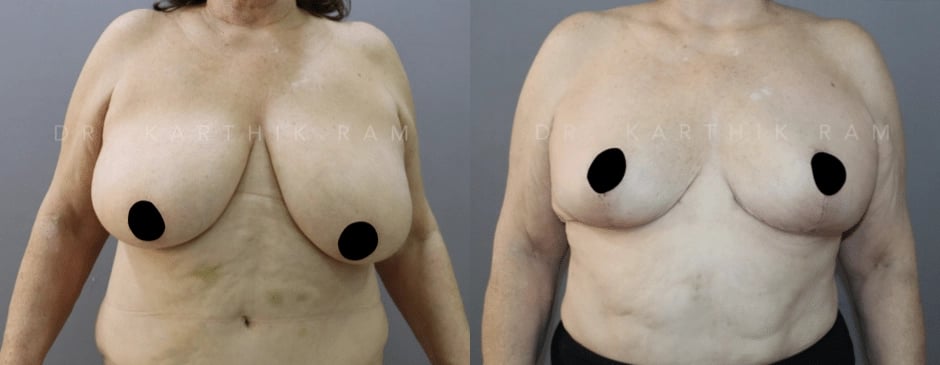 breast reduction breast lift before and after photo by chennai plastic surgery in india