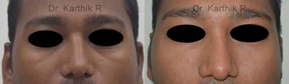 dermal fillers before and after photo by chennai plastic surgery in india