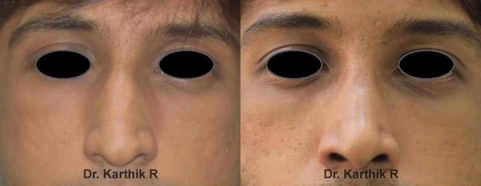 rhinoplasty before and after photo by chennai plastic surgery in india
