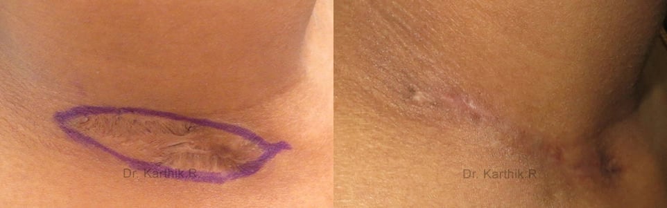 scar revision before and after photo by chennai plastic surgery in india