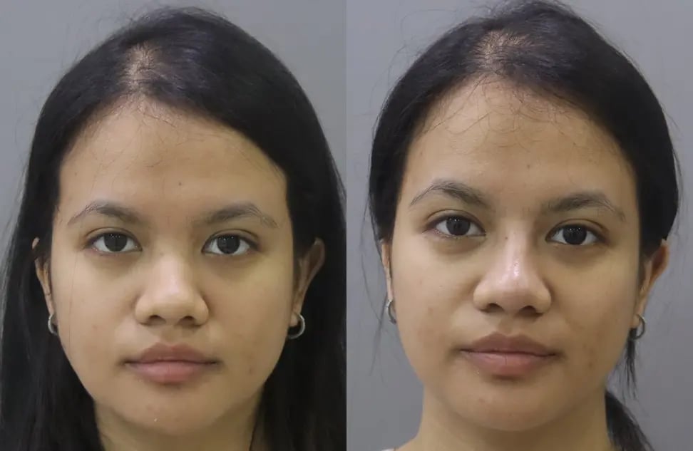 dermal fillers before and after photo by chennai plastic surgery in india