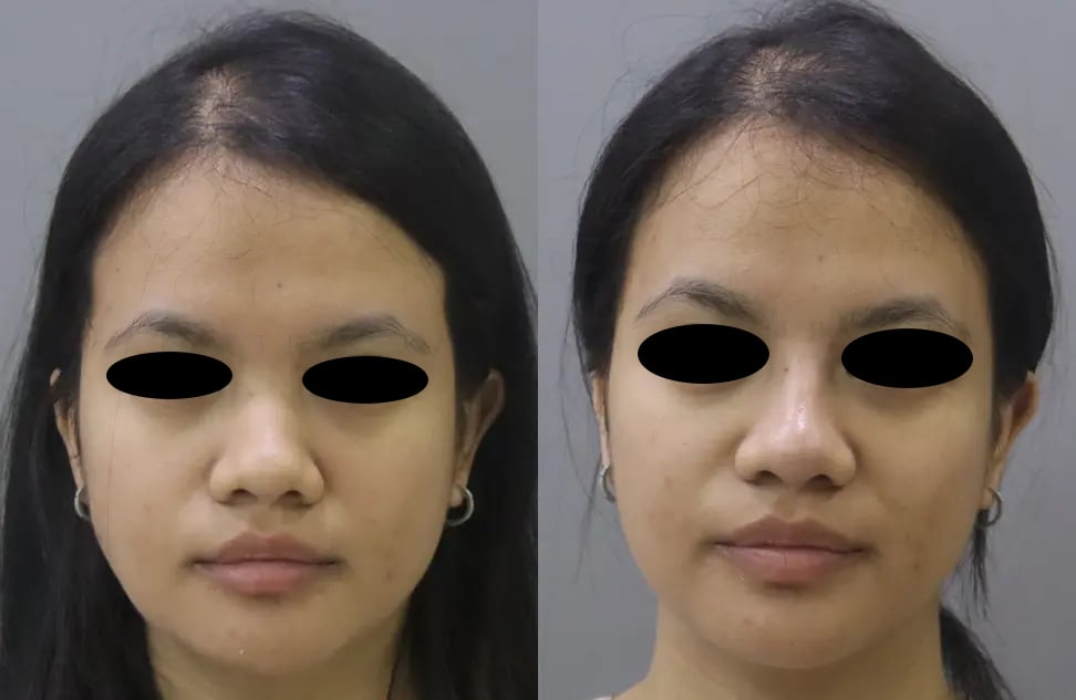 dermal fillers before and after photo by chennai plastic surgery in india