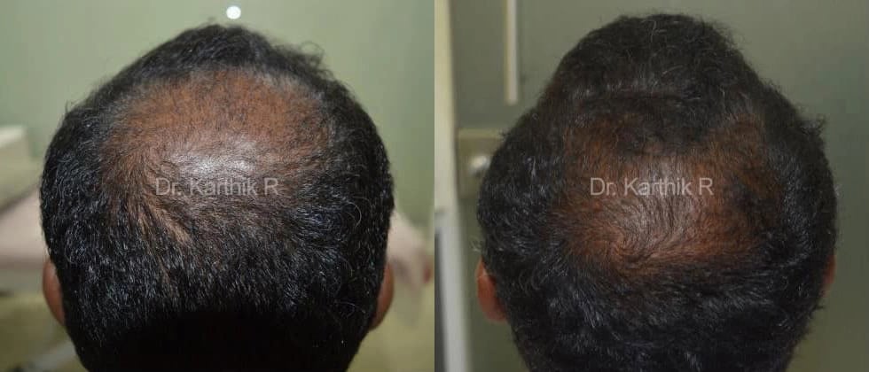 dermaroller scalp before and after photo by chennai plastic surgery in india